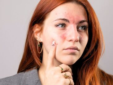 Rosacea [Canva]