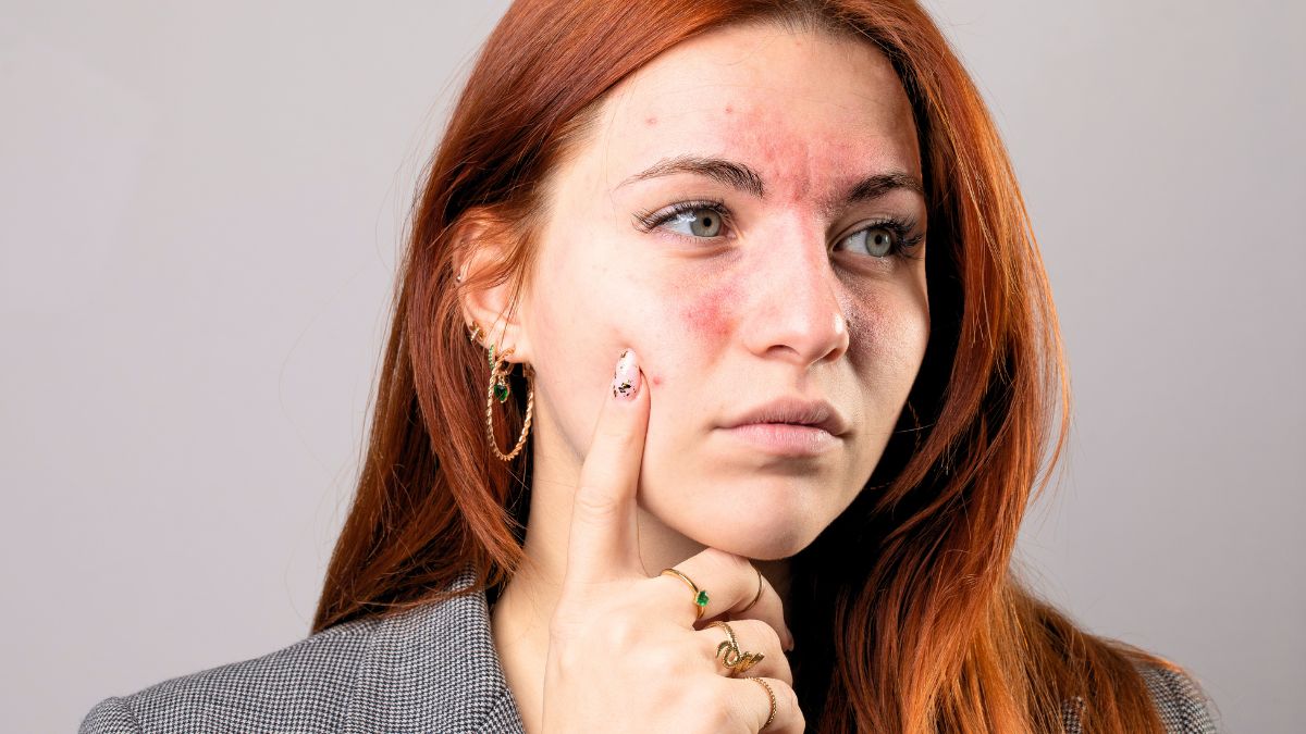 Rosacea [Canva]